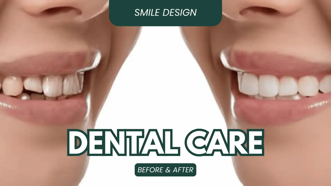 What Is Smile Design in Dentistry