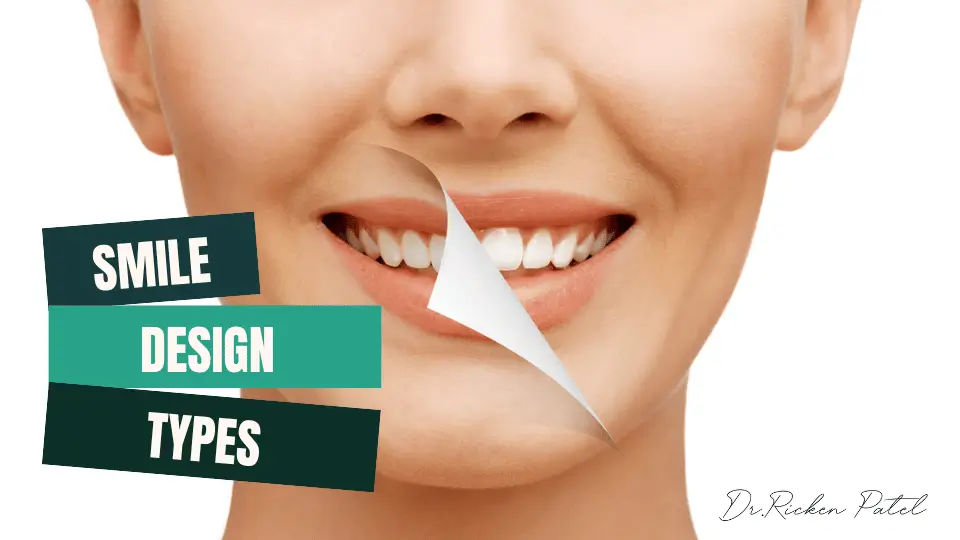Smile Design Types