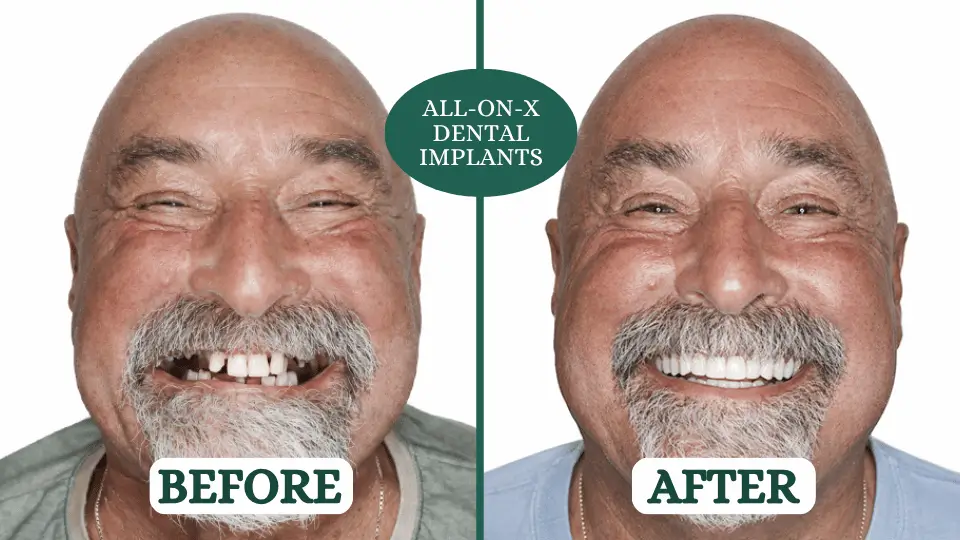 All-on-X dental implants