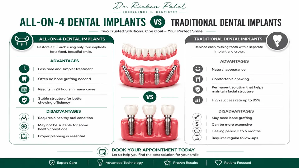 Pros and Cons of All on 4 Dental Implants