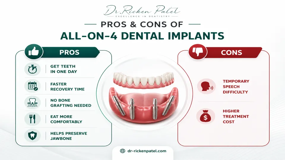 Pros and Cons of All on 4 Dental Implants.
