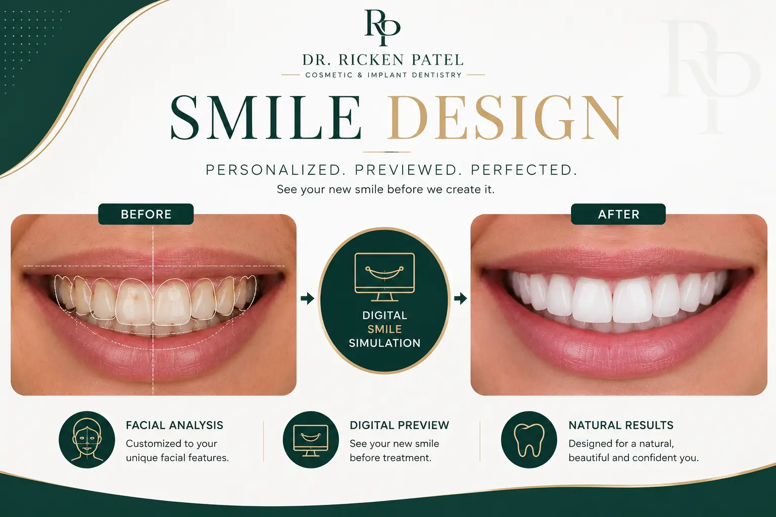 What Is Smile Design in Dentistry