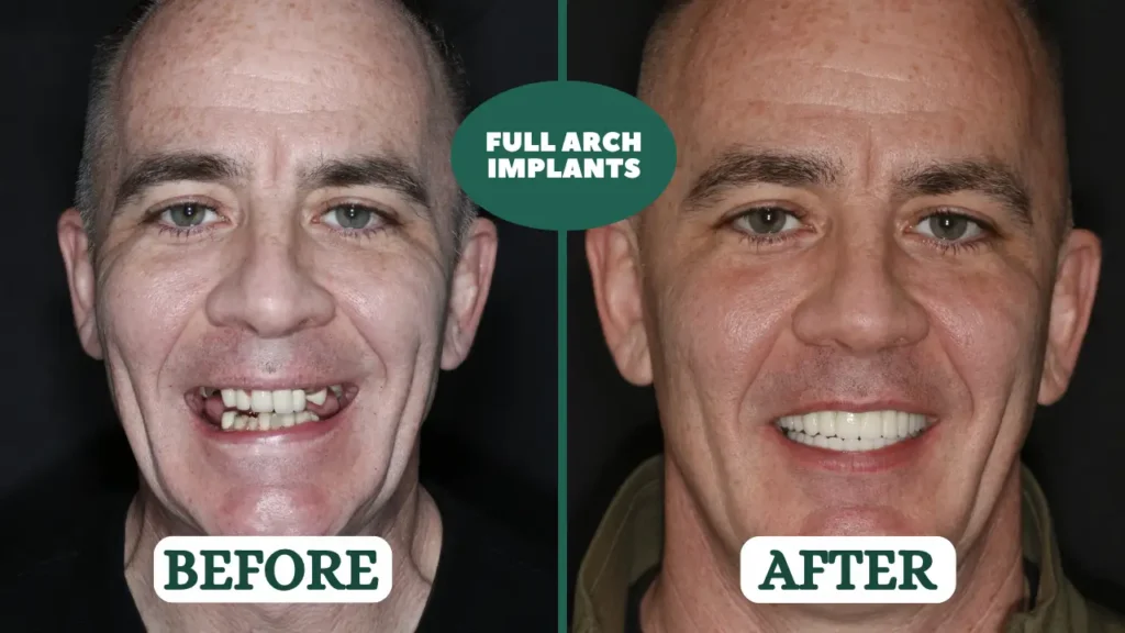 All-on-4 Dental Implants