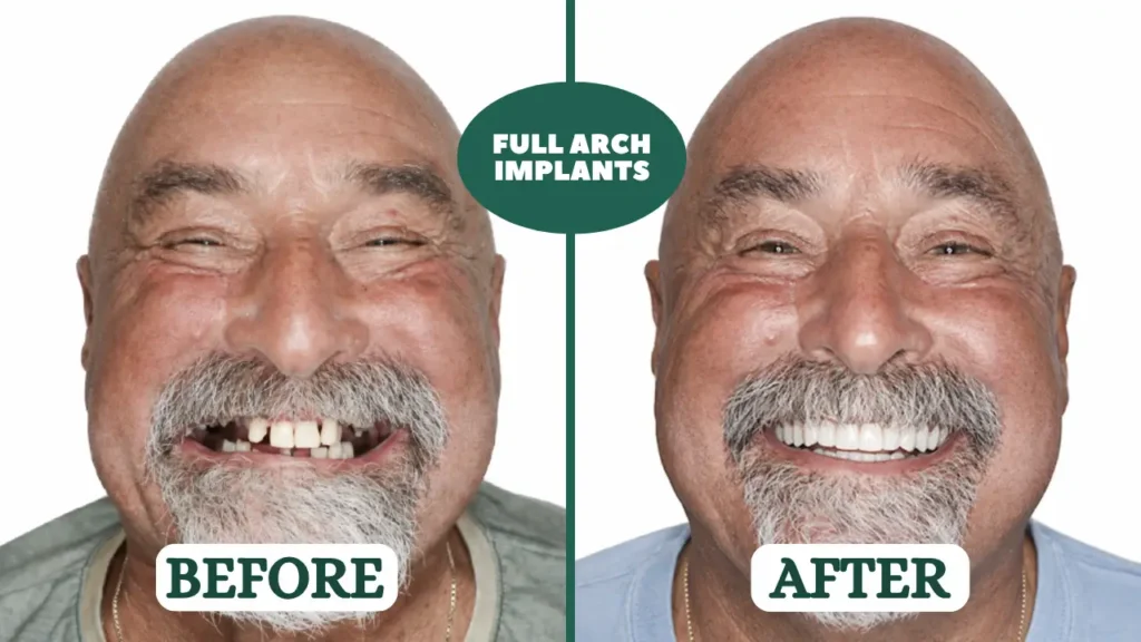 all-on-6 dental implants