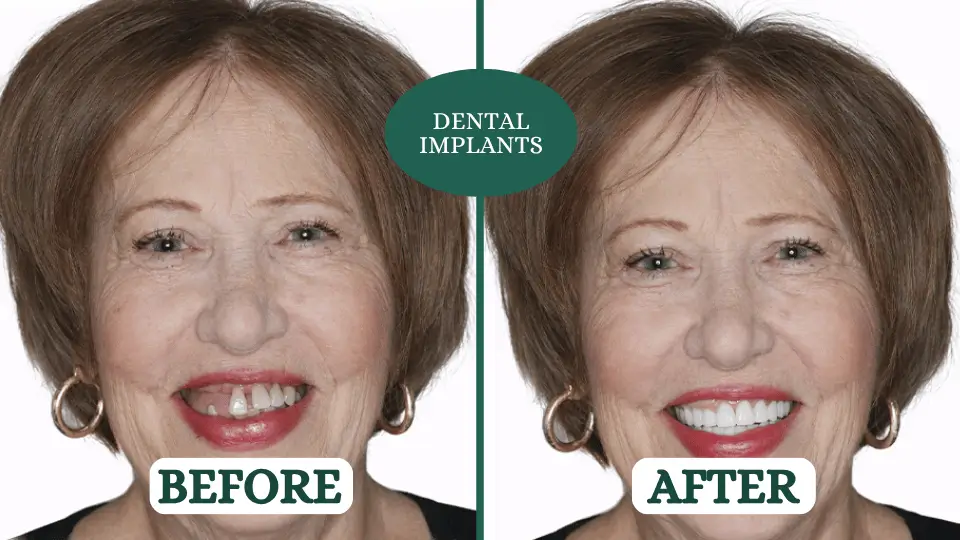 dental implants