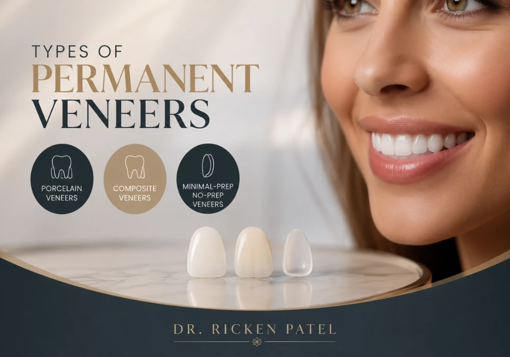 Permanent Veneers Price