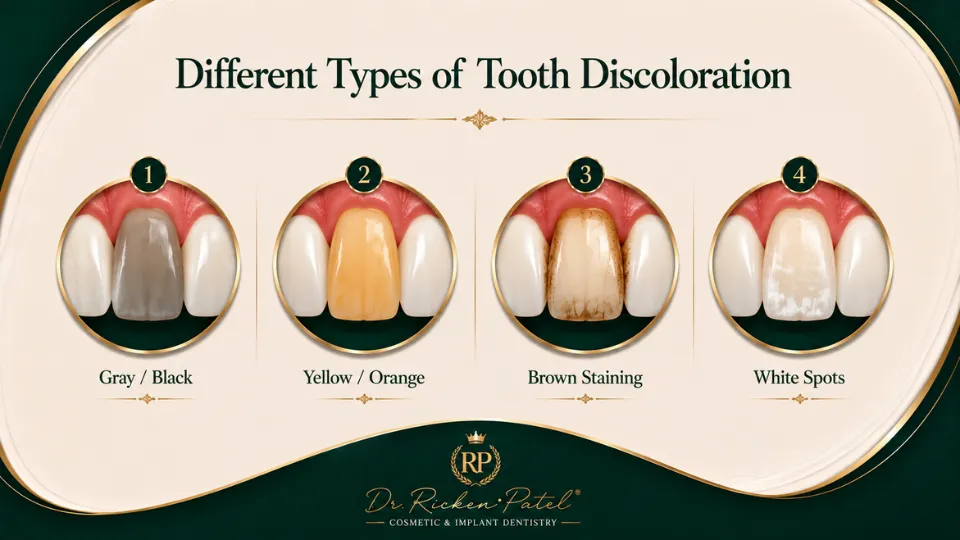 How to Fix One Discolored Tooth How to Fix One Discolored Tooth