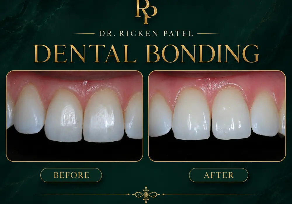 How to Hide Gaps Between Front Teeth