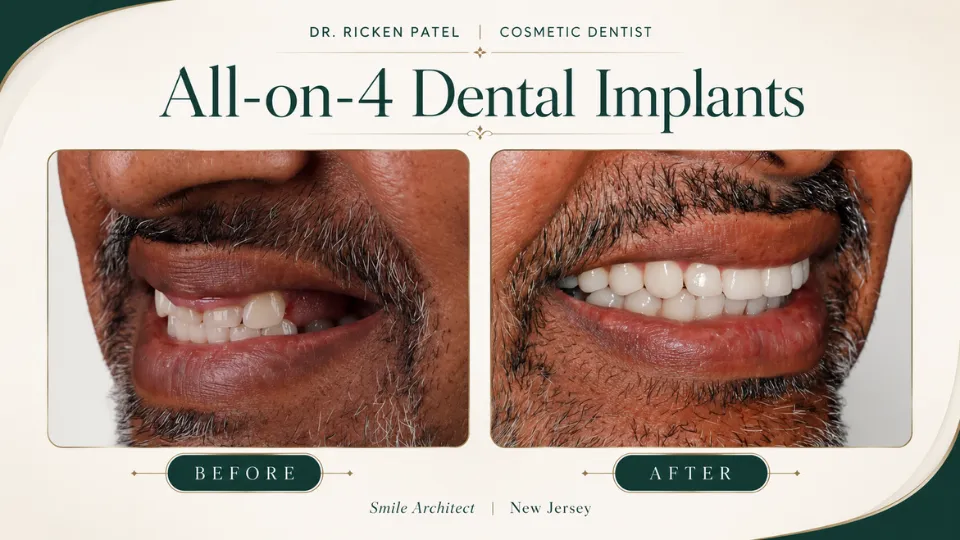 What Are Options for Missing Teeth