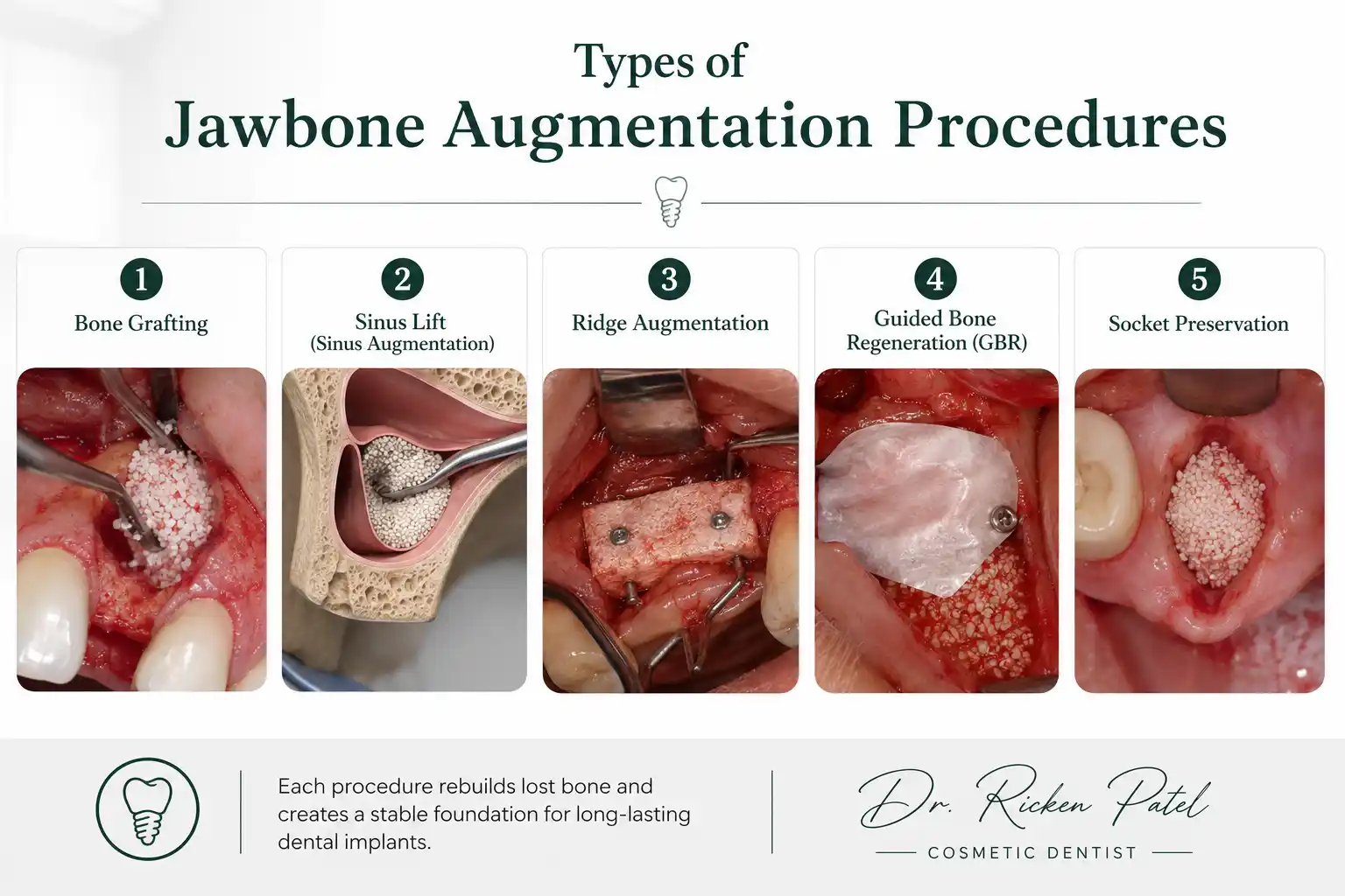 Jawbone Augmentation Before Implants