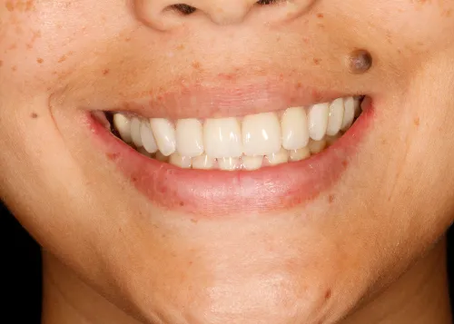Close up of a patient smile after cosmetic treatment at Smiles Family Dentistry