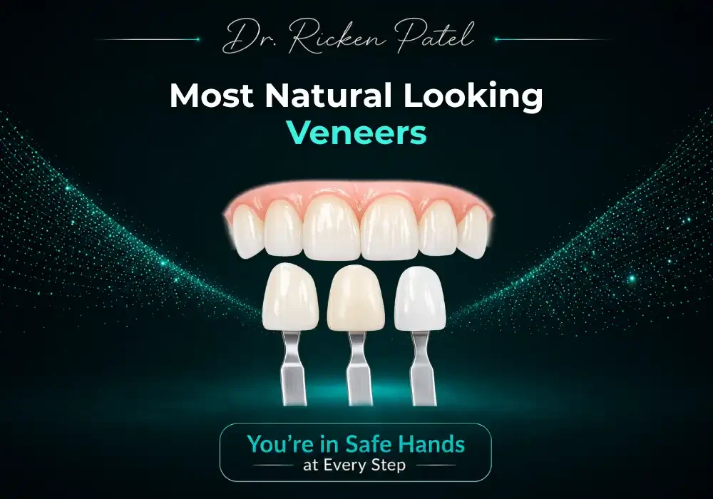 Most Natural Looking Veneers